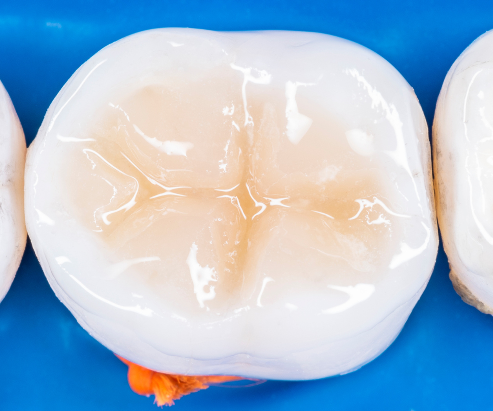 White Fillings A Safe, Aesthetic Solution for Treating Cavities in Children