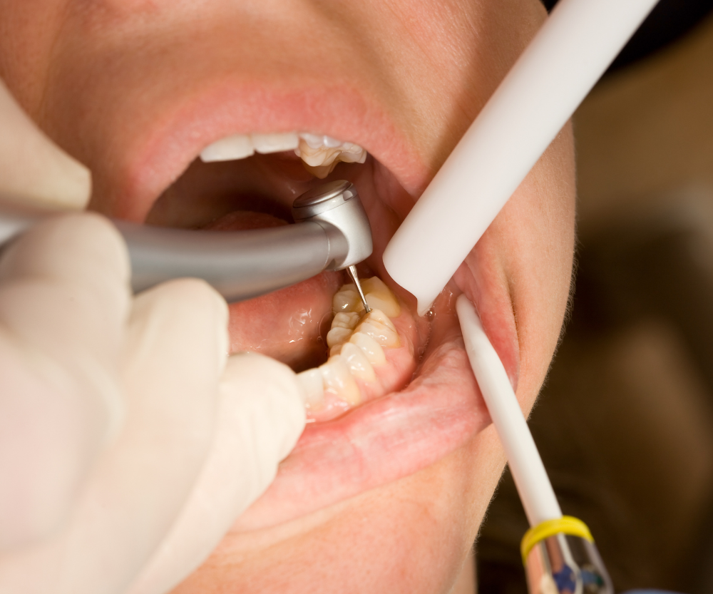 Why Is a Stainless Steel Crown Sometimes the Best Option for a Baby Tooth