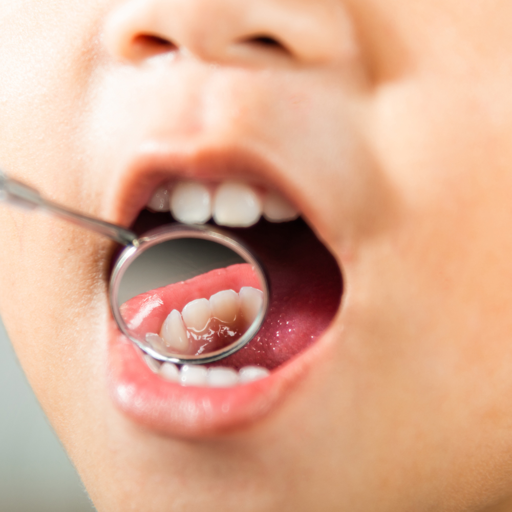 Why Should I Treat a Cavity on My Child’s Baby Tooth if It Will Fall Out Anyway