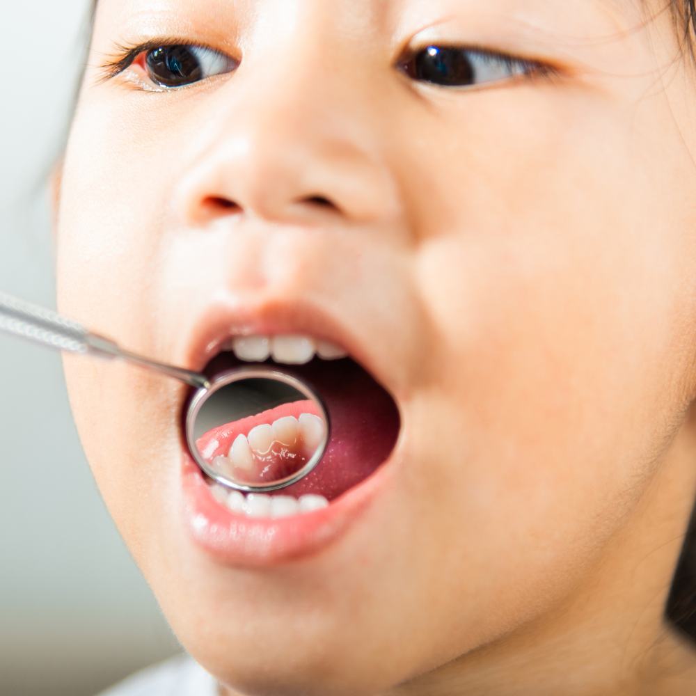Treating a Cavity on a Baby Tooth Essential Care for Long Island Families